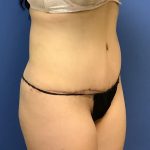 Tummy Tuck Before & After Patient #2739
