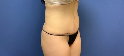 Tummy Tuck Before & After Patient #2739