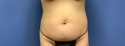 Tummy Tuck Before & After Patient #2739