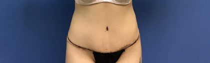 Tummy Tuck Before & After Patient #2739