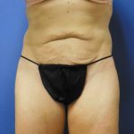 Tummy Tuck Before & After Patient #2744