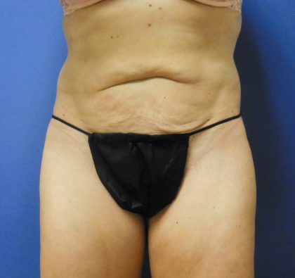 Tummy Tuck Before & After Patient #2744