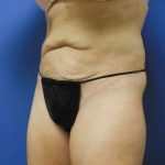 Tummy Tuck Before & After Patient #2744