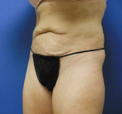 Tummy Tuck Before & After Patient #2744