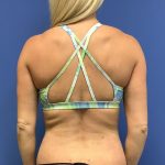 Tummy Tuck Before & After Patient #2749