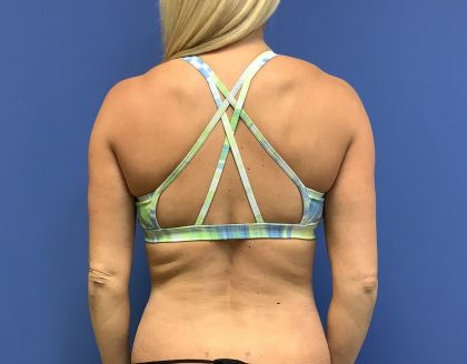 Tummy Tuck Before & After Patient #2749