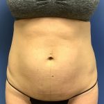 Tummy Tuck Before & After Patient #2749