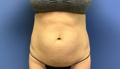 Tummy Tuck Before & After Patient #2749