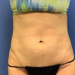 Tummy Tuck Before & After Patient #2749