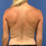 Tummy Tuck Before & After Patient #2749