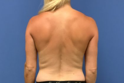 Tummy Tuck Before & After Patient #2749