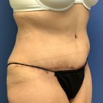 Tummy Tuck Before & After Patient #2754