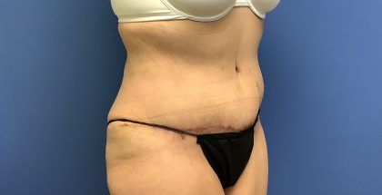 Tummy Tuck Before & After Patient #2754