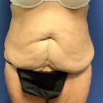 Tummy Tuck Before & After Patient #2754