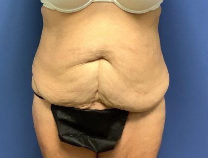 Tummy Tuck Before & After Patient #2754