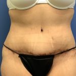 Tummy Tuck Before & After Patient #2754