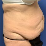 Tummy Tuck Before & After Patient #2754