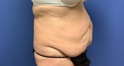 Tummy Tuck Before & After Patient #2754