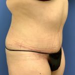 Tummy Tuck Before & After Patient #2759