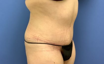 Tummy Tuck Before & After Patient #2759