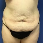 Tummy Tuck Before & After Patient #2759