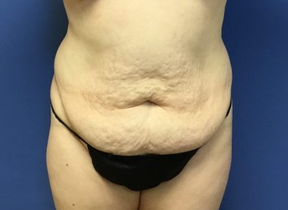Tummy Tuck Before & After Patient #2759