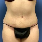 Tummy Tuck Before & After Patient #2759