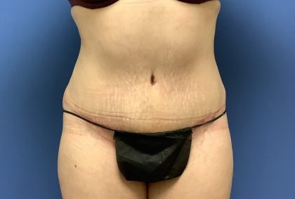 Tummy Tuck Before & After Patient #2759