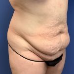 Tummy Tuck Before & After Patient #2759