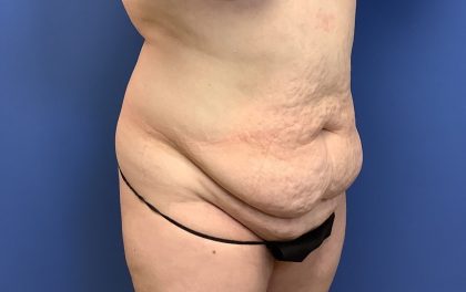 Tummy Tuck Before & After Patient #2759