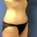 Tummy Tuck Before & After Patient #2764