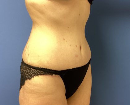 Tummy Tuck Before & After Patient #2764