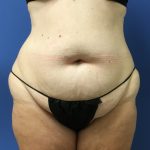Tummy Tuck Before & After Patient #2764
