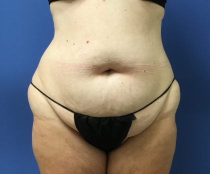 Tummy Tuck Before & After Patient #2764