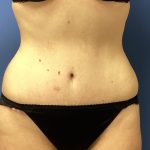 Tummy Tuck Before & After Patient #2764