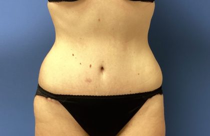 Tummy Tuck Before & After Patient #2764
