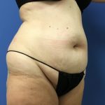 Tummy Tuck Before & After Patient #2764