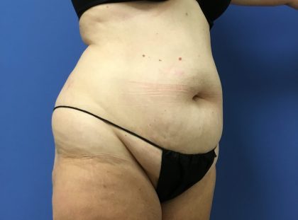 Tummy Tuck Before & After Patient #2764