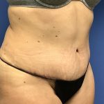 Tummy Tuck Before & After Patient #2769