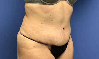 Tummy Tuck Before & After Patient #2769