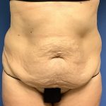 Tummy Tuck Before & After Patient #2769