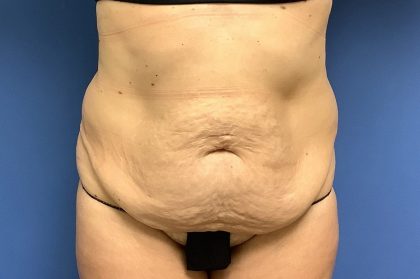 Tummy Tuck Before & After Patient #2769