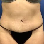 Tummy Tuck Before & After Patient #2769