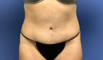 Tummy Tuck Before & After Patient #2769