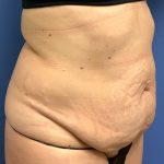 Tummy Tuck Before & After Patient #2769