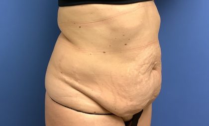 Tummy Tuck Before & After Patient #2769