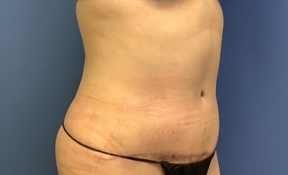 Tummy Tuck Before & After Patient #2774