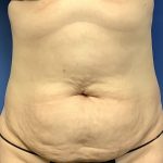 Tummy Tuck Before & After Patient #2774