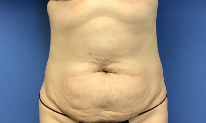 Tummy Tuck Before & After Patient #2774