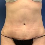 Tummy Tuck Before & After Patient #2774